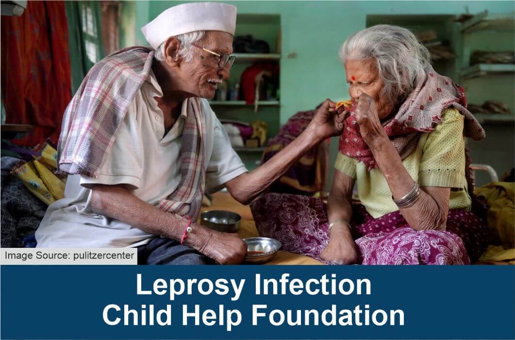Leprosy Infection Child Help Foundation