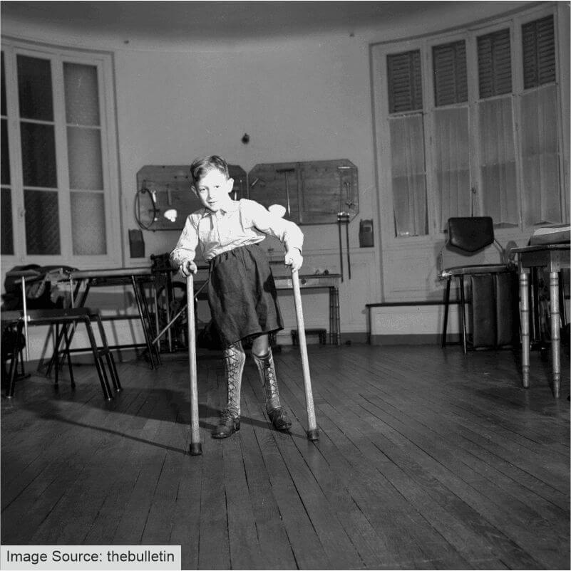 A black-and-white picture of a Polio patient